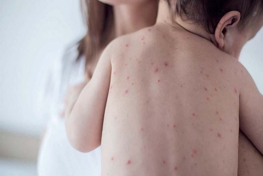 Alerta: ¿puede haber un brote de sarampión?